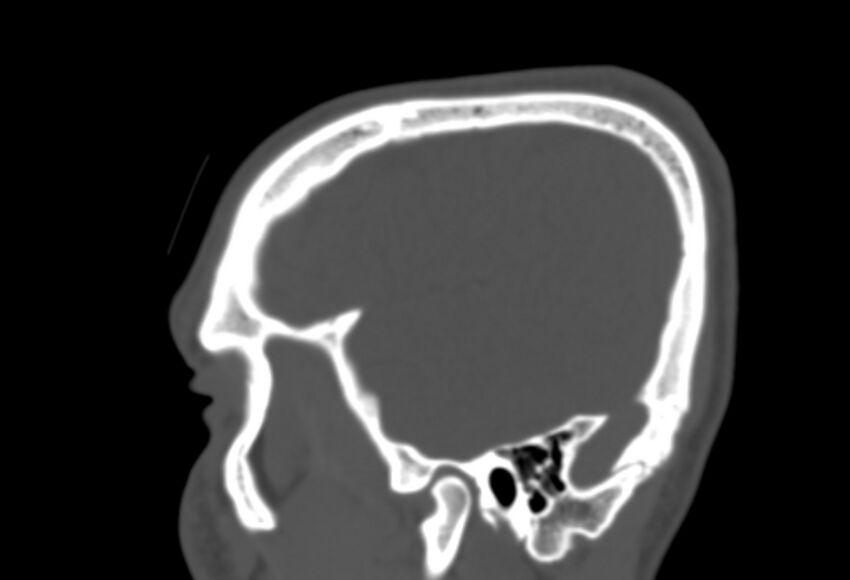 Asymptomatic occipital spur (Radiopaedia 87753-104201 Sagittal bone window 40).jpg