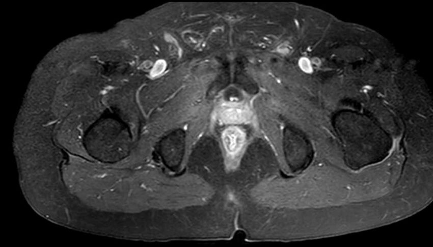 Atypical lipomatous tumor - thigh (Radiopaedia 68975-78734 Axial T1 C+ fat sat 86).jpg