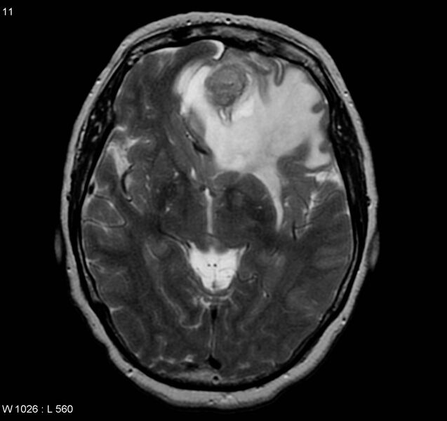File:Atypical meningioma (WHO grade II) (Radiopaedia 5273-7016 Axial T2 4).jpg