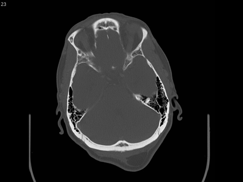 Atypical meningioma - intraosseous (Radiopaedia 64915-73867 Axial C+ bone window 23).jpg
