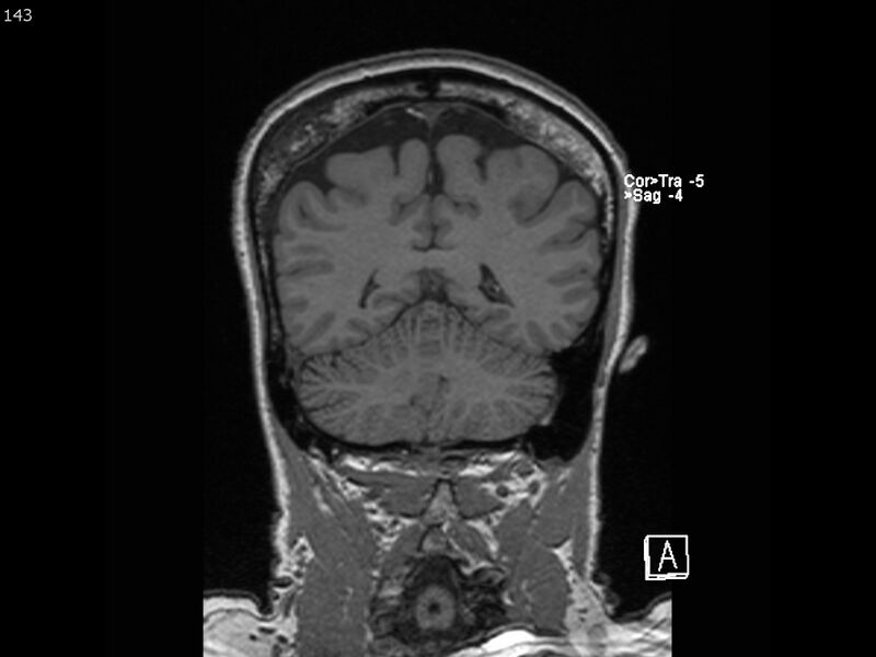 File:Atypical meningioma - intraosseous (Radiopaedia 64915-74572 Coronal T1 143).jpg