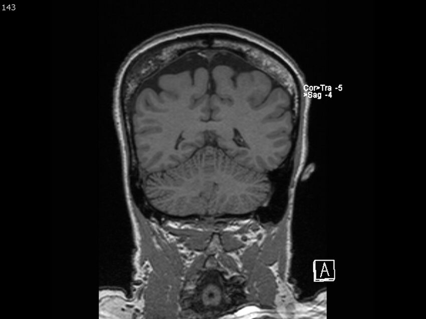 Atypical meningioma - intraosseous (Radiopaedia 64915-74572 Coronal T1 143).jpg