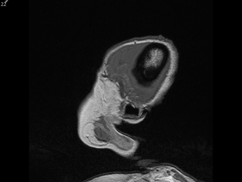 File:Atypical meningioma - intraosseous (Radiopaedia 64915-74572 Sagittal T1 22).jpg