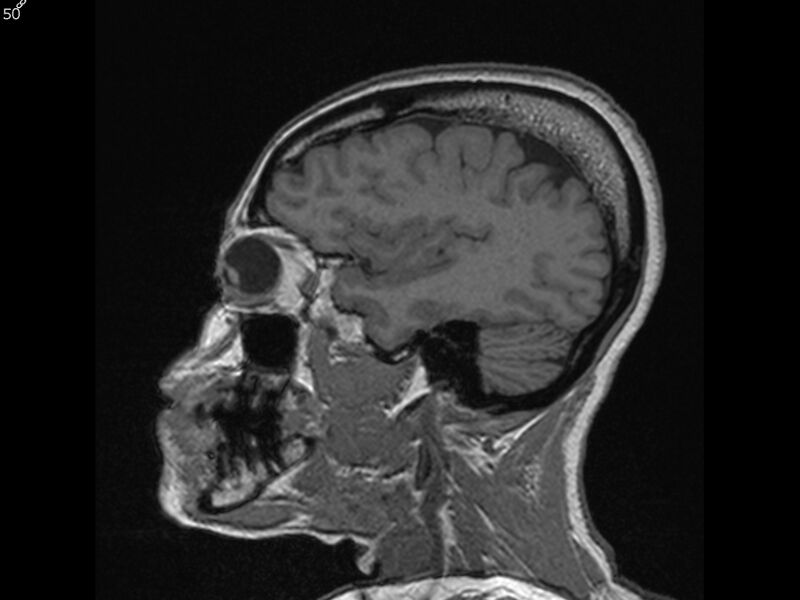 File:Atypical meningioma - intraosseous (Radiopaedia 64915-74572 Sagittal T1 50).jpg