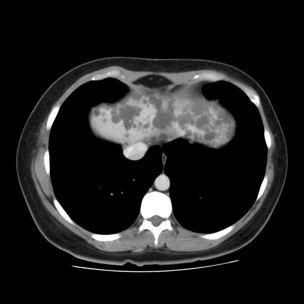 File:Autosomal dominant polycystic kidney disease (Radiopaedia 23061-23093 C 5).jpg