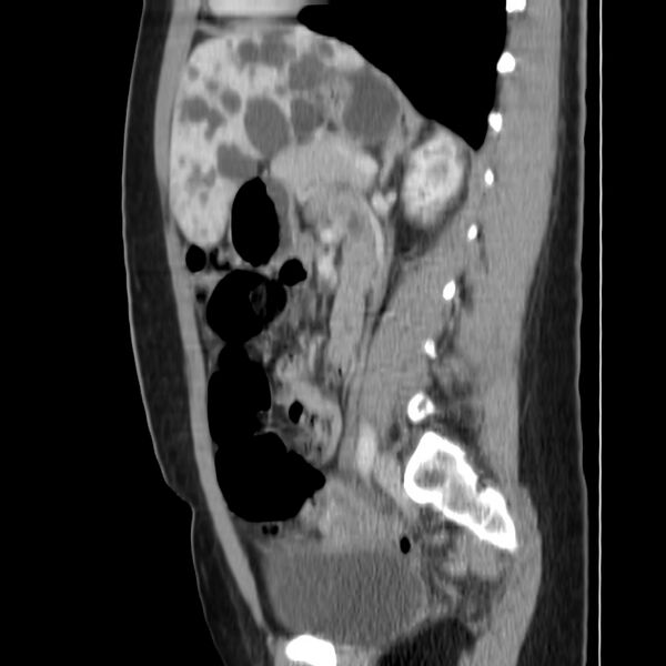 File:Autosomal dominant polycystic kidney disease (Radiopaedia 23061-23093 F 34).jpg