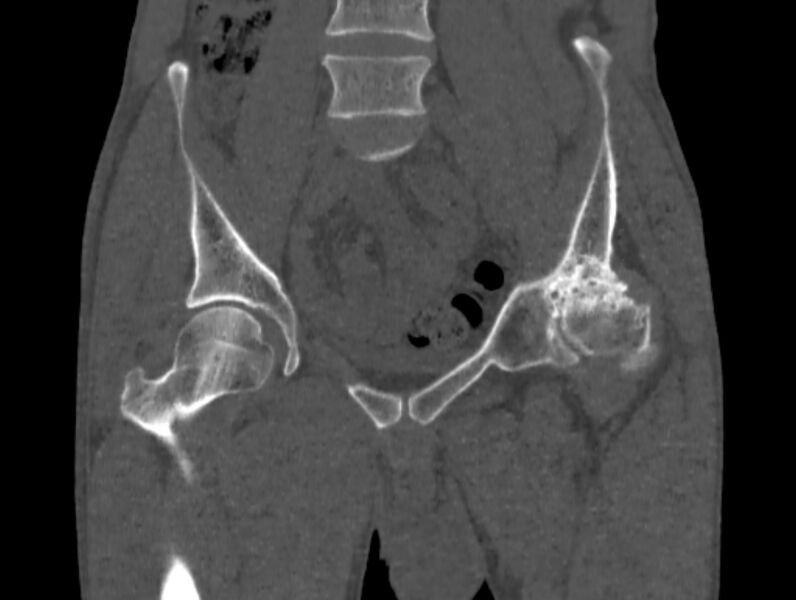 File:Avascular necrosis of the left hip (Radiopaedia 75068-86125 Coronal bone window 16).jpg