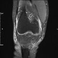 Avulsion fracture of the fibular head (Radiopaedia 74804-85808 Coronal PD fat sat 12).jpg