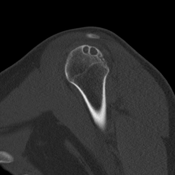 File:Bankart lesion (Radiopaedia 22771-22798 Sagittal bone window 13).jpg