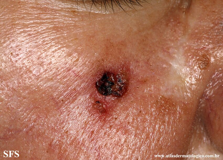 Basal Cell Carcinoma (Dermatology Atlas 330).jpg