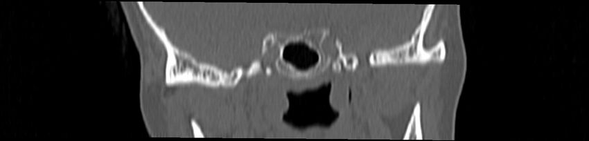 Basilar impression (Radiopaedia 52411-58522 Coronal bone window 45).jpg
