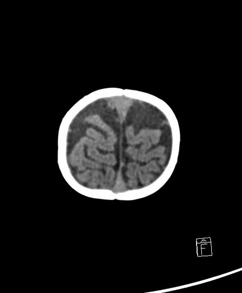 File:Benign enlargement of subarachnoid spaces in infancy (BESS) (Radiopaedia 87459-103795 Axial non-contrast 8).jpg