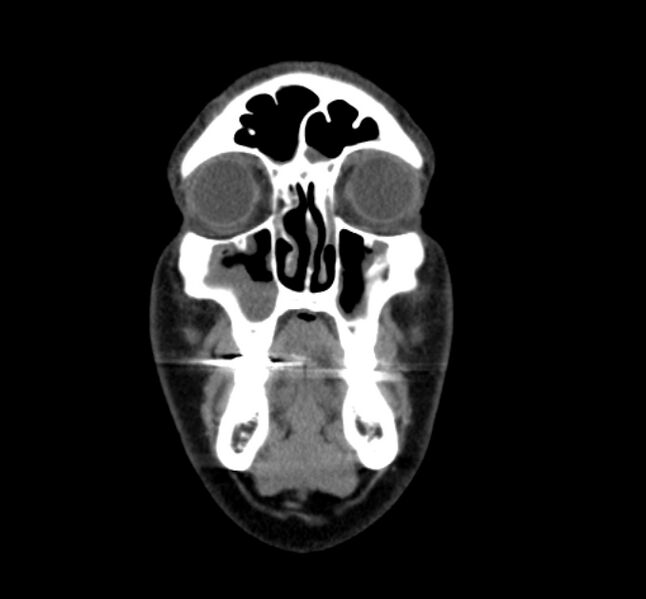 File:Benign mixed salivary tumor of the parotid gland (Radiopaedia 35261-36792 B 1).jpg