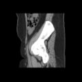 Bicornuate uterus- on MRI (Radiopaedia 49206-54296 A 2).jpg
