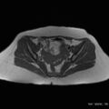 Bicornuate uterus- on MRI (Radiopaedia 49206-54297 Axial T1 6).jpg