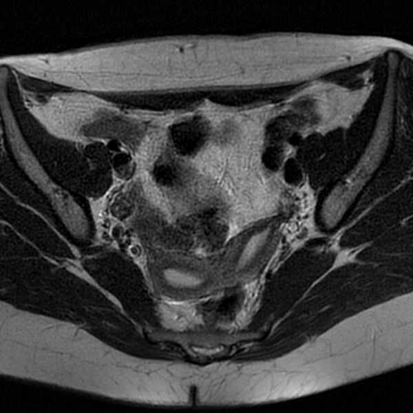 File:Bicornuate uterus (Radiopaedia 72135-82643 Axial T2 8).jpg