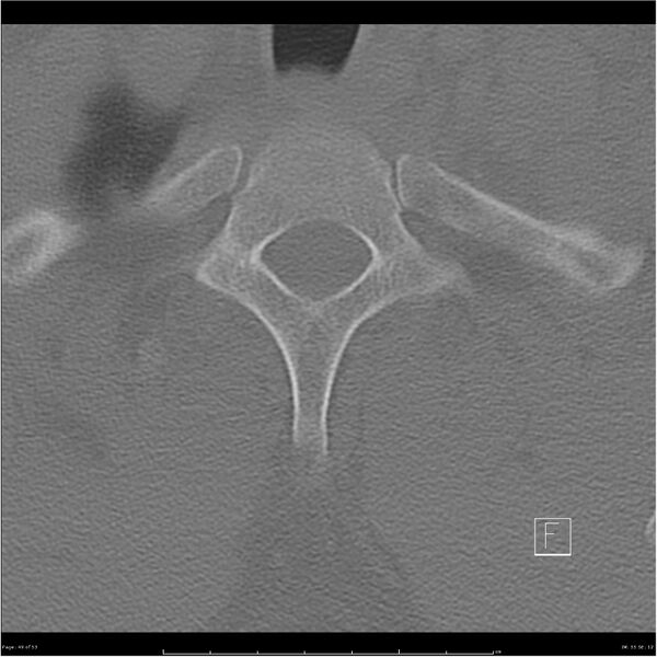 File:Bilateral cervical ribs (Radiopaedia 25868-26017 Axial bone window 49).jpg