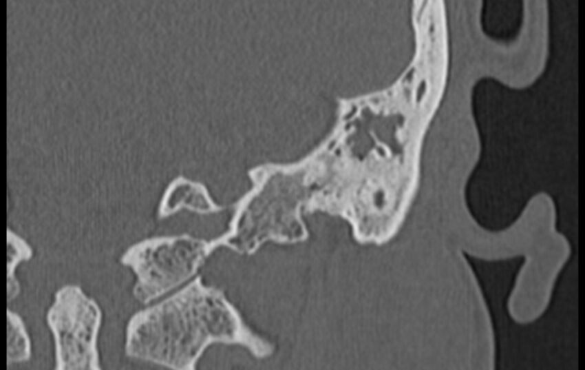 Bilateral cholesteatoma (Radiopaedia 54898-61172 D 47).jpg