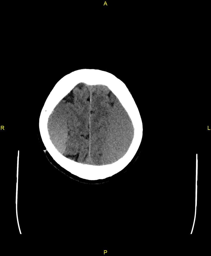 Bilateral isodense subdural hematomas (Radiopaedia 88621-105325 Axial non-contrast 92).jpg