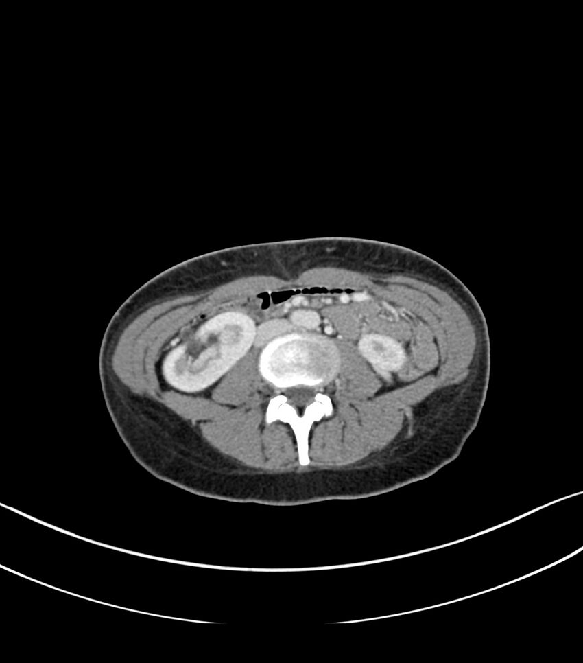 Bilateral kidney malrotation (Radiopaedia 72227-82749 A 35).jpg