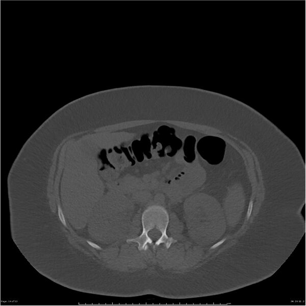 File:Bilateral lumbar ribs (Radiopaedia 25862-26010 bone window 14).jpg
