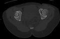 Bilateral mature cystic ovarian teratoma (Radiopaedia 88821-105592 Axial bone window 38).jpg