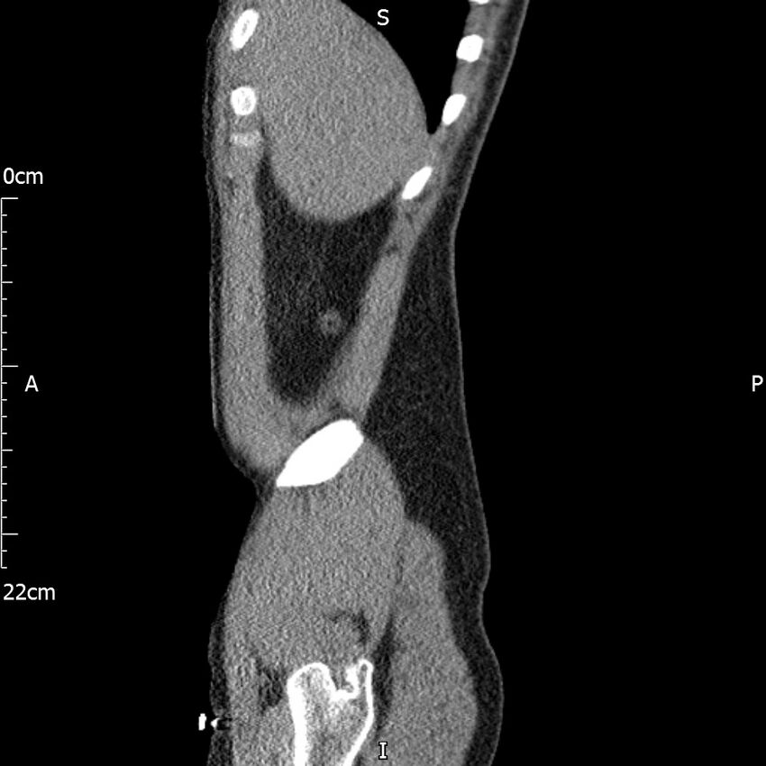 Bilateral medullary nephrocalcinosis with ureteric calculi (Radiopaedia 71269-81569 C 100).jpg