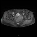 Bilateral ovarian fibroma (Radiopaedia 44568-48293 Axial T1 C+ fat sat 18).jpg
