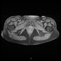 Bilateral ovarian fibroma (Radiopaedia 44568-48293 Axial T1 fat sat 27).jpg