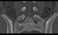 Bilateral pars defect (Radiopaedia 26691-26846 Coronal bone window 24).jpg