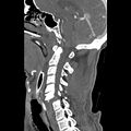 Bilateral perched facets with cord injury (Radiopaedia 45587-49713 B 23).jpg