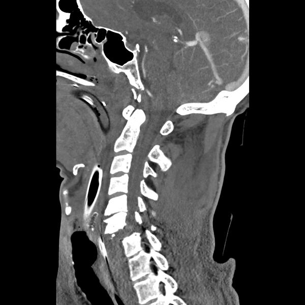 File:Bilateral perched facets with cord injury (Radiopaedia 45587-49713 B 23).jpg