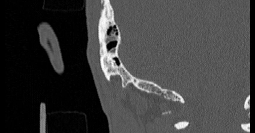 Bilateral temporal bone fractures (Radiopaedia 29482-29970 Coronal non-contrast 180).jpg
