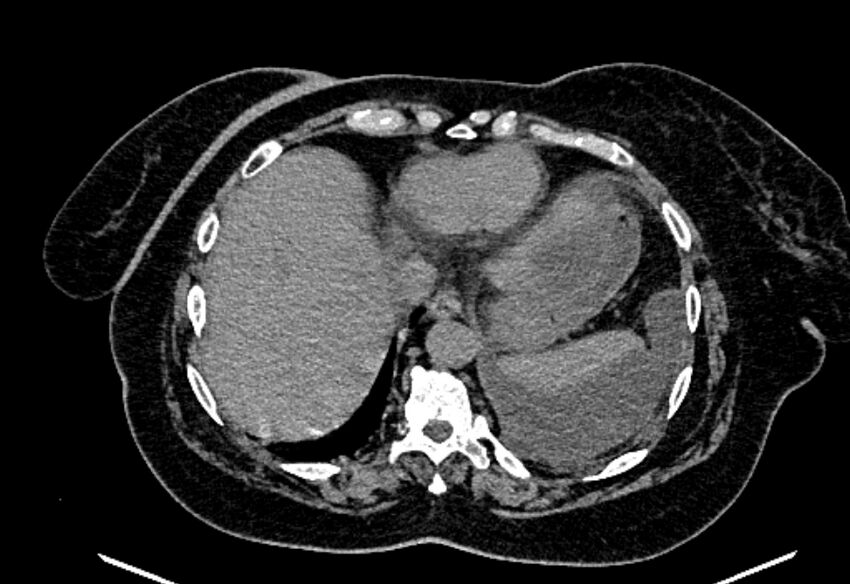 Biliary pancreatitis (Radiopaedia 72289-82823 Axial non-contrast 44).jpg
