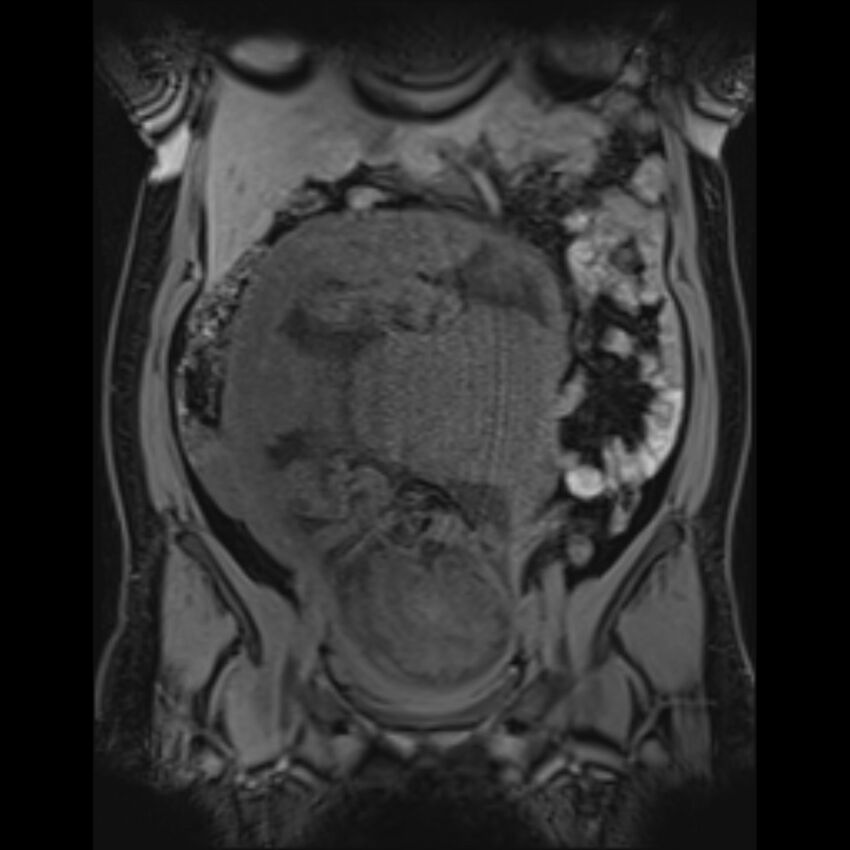 Bilobed placenta accreta (Radiopaedia 69648-79591 Coronal T1 vibe 81).jpg