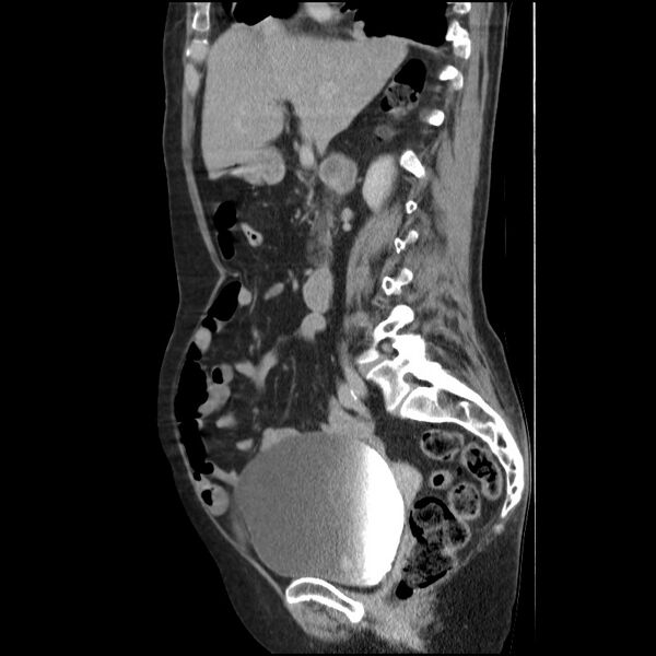 File:Bladder tumor detected on trauma CT (Radiopaedia 51809-57609 E 43).jpg