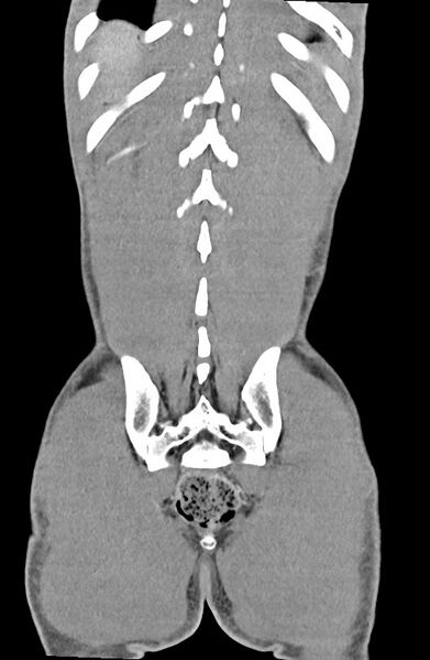 File:Blunt injury to the small bowel (Radiopaedia 74953-85987 B 83).jpg