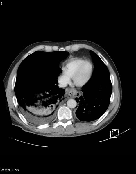 File:Boerhaave syndrome with tension pneumothorax (Radiopaedia 56794-63603 A 1).jpg