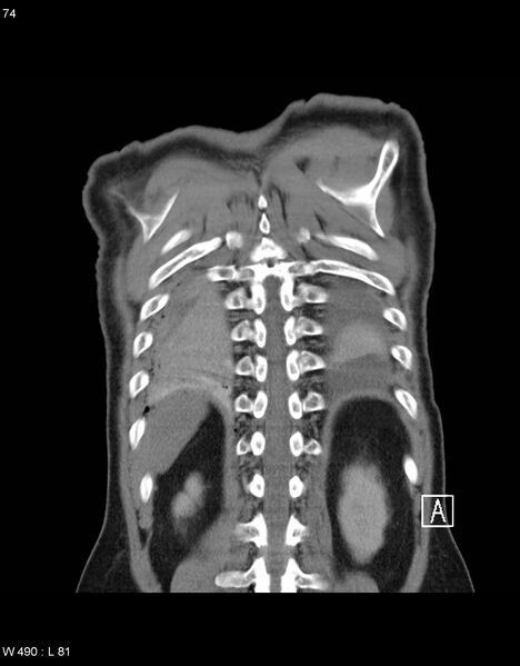 File:Boerhaave syndrome with tension pneumothorax (Radiopaedia 56794-63605 B 32).jpg