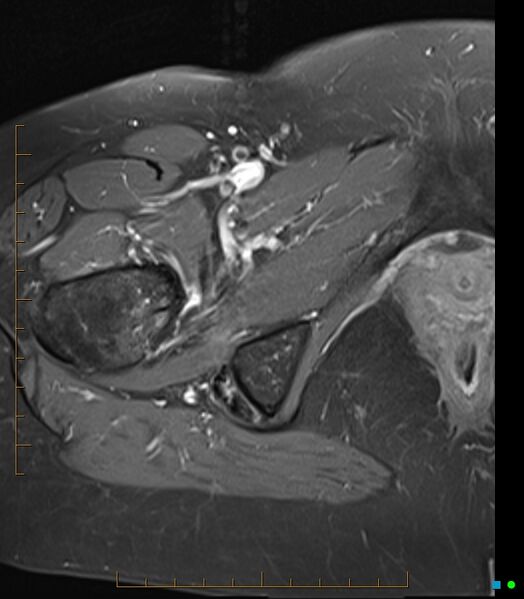 File:Bone metastasis - breast cancer (Radiopaedia 16667-16374 Axial T1 C+ fat sat 5).jpg
