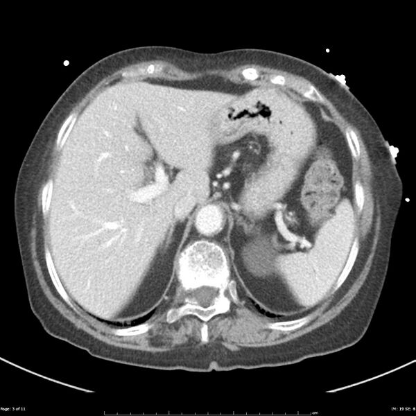 File:Bosniak renal cyst - type IIF (Radiopaedia 23385-23450 A 3).jpg