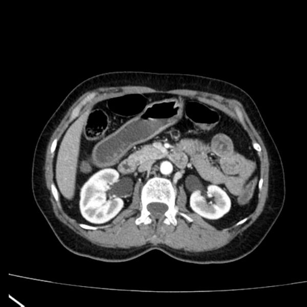 File:Bosniak renal cyst - type I (Radiopaedia 27479-27675 renal cortical phase 32).jpg