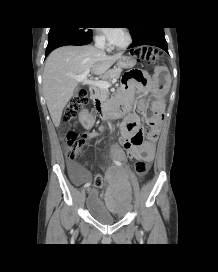Bowel lymphoma complicated by bleeding after therapy (Radiopaedia 55601-62107 B 31).jpg