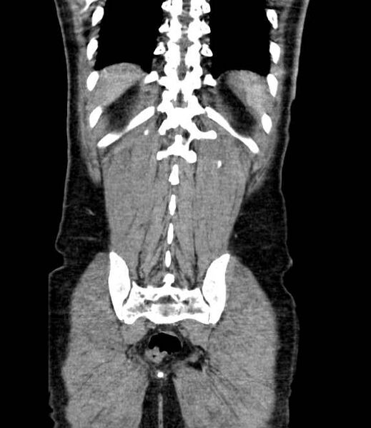 File:Bowel obstruction from colon carcinoma (Radiopaedia 22995-23028 C 64).jpg