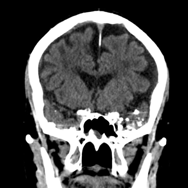 File:Brain Pantopaque remnants (Radiopaedia 78403-91048 Coronal non-contrast 27).jpg