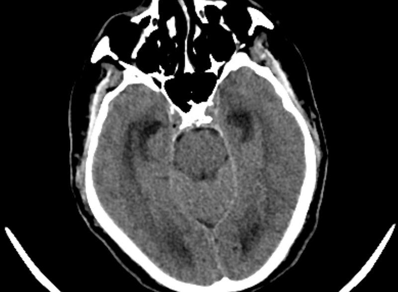 File:Brain abscess complicated by intraventricular rupture and ventriculitis (Radiopaedia 82434-96575 Axial non-contrast 4).jpg