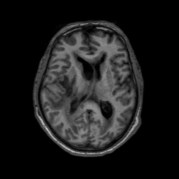 File:Brain abscess complicated by intraventricular rupture and ventriculitis (Radiopaedia 82434-96577 Axial T1 37).jpg