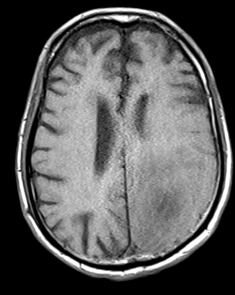 File:Brain abscess with dual rim sign (Radiopaedia 87566-103938 Axial T1 16).jpg