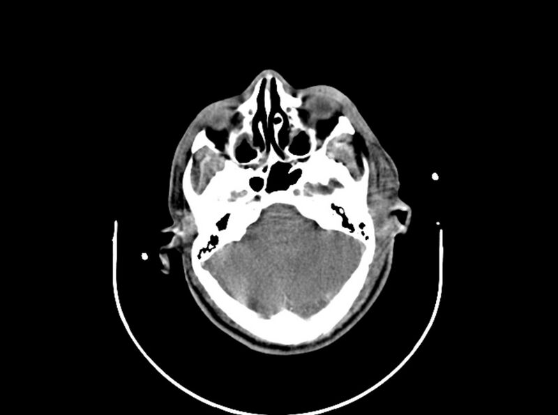File:Brain injury by firearm projectile (Radiopaedia 82068-96087 B 65).jpg