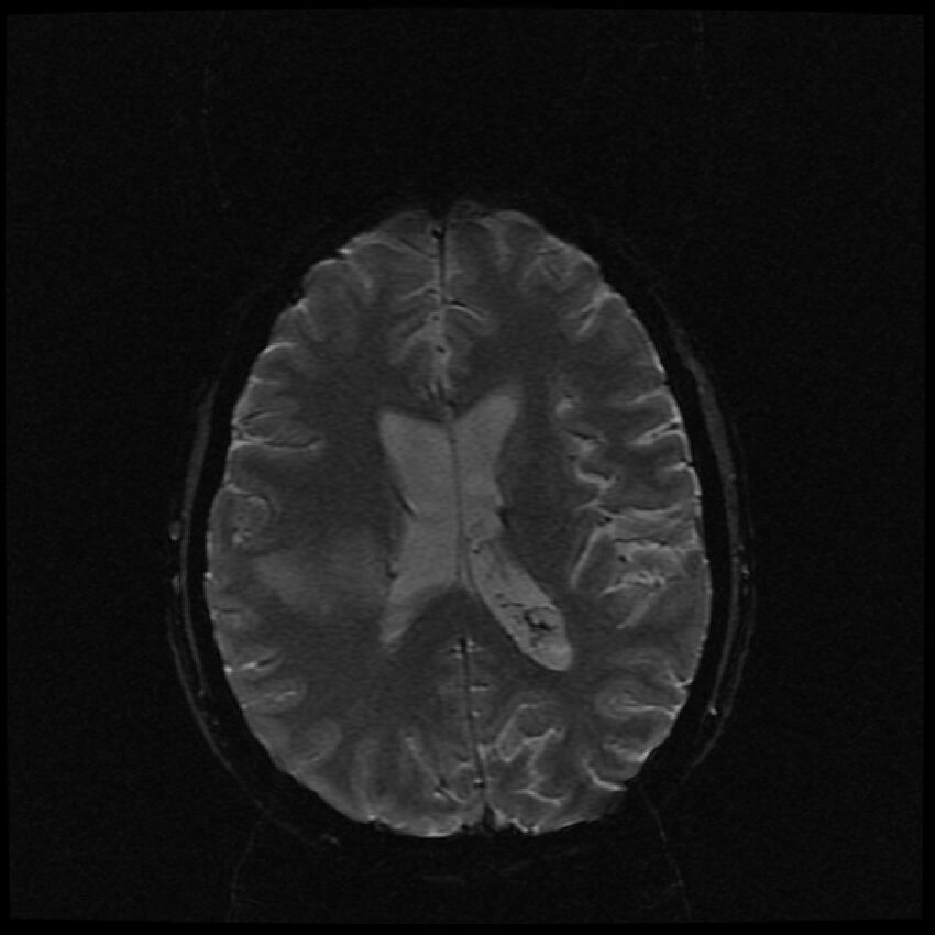Brain metastases (renal cell carcinoma) (Radiopaedia 42571-45704 Axial SWI 23).jpg